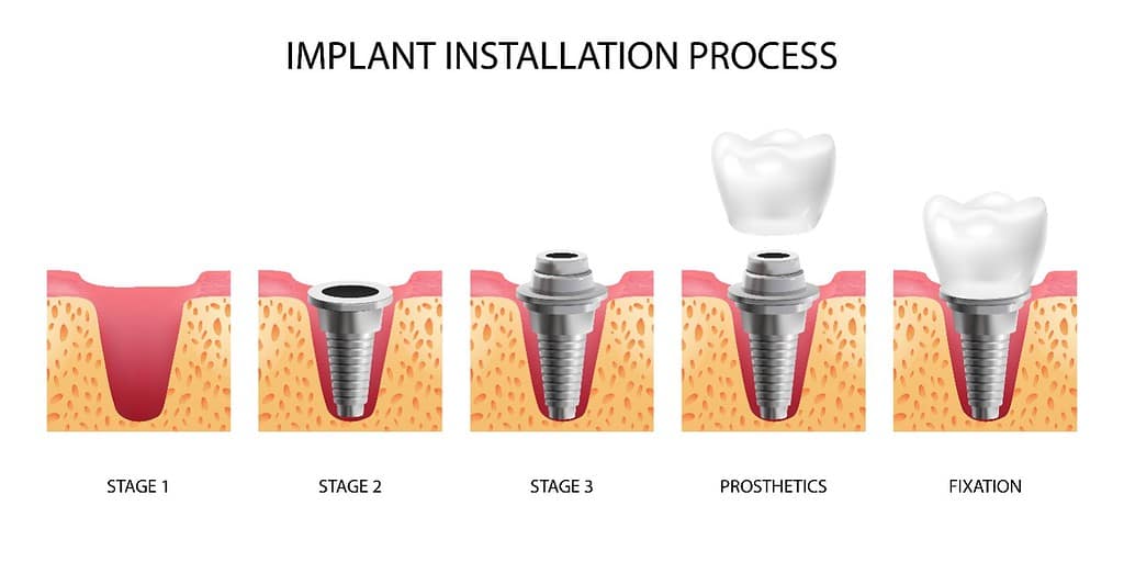 cirugía de implantes dentales en Albania