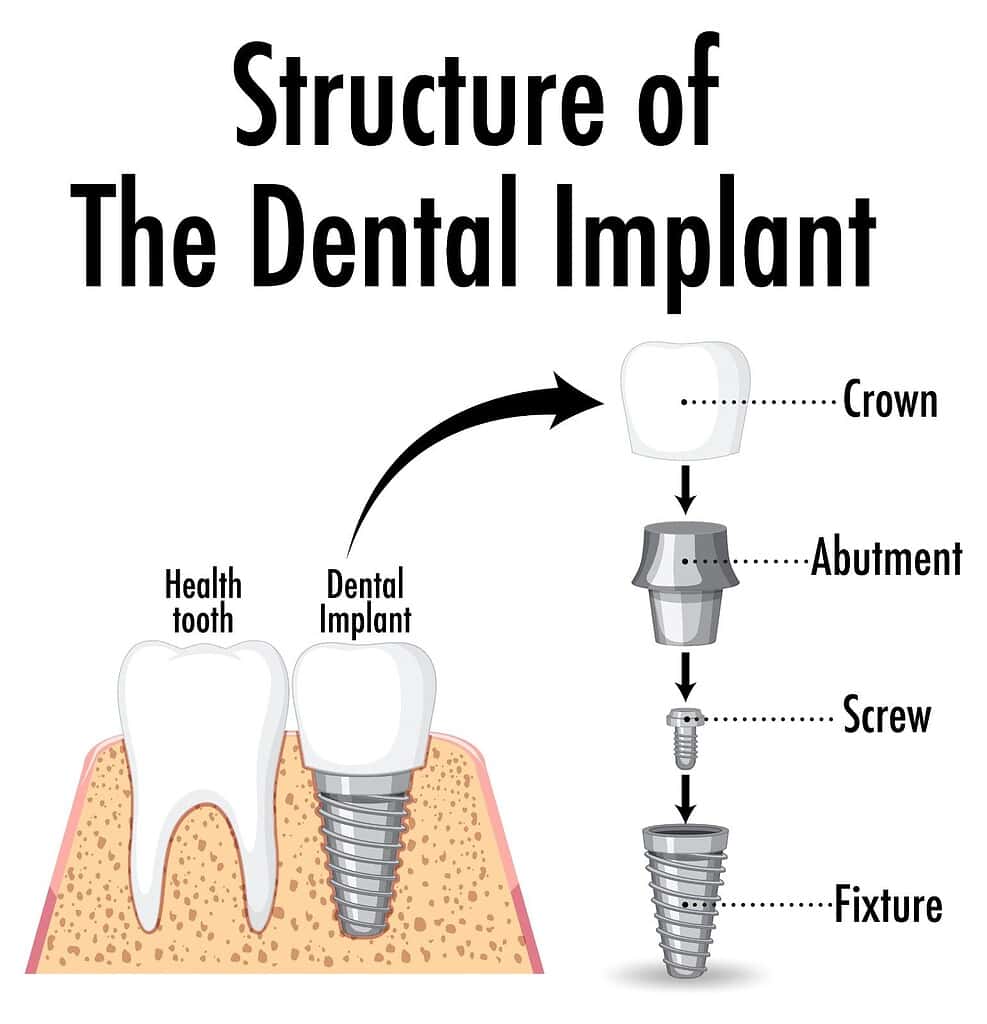estructura del implante dental