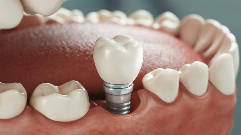 Implantet Dentare ne Shqiperi