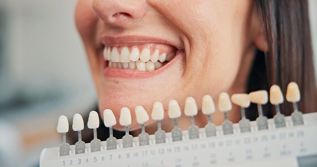 Fasetat Dentare ne Shqiperi