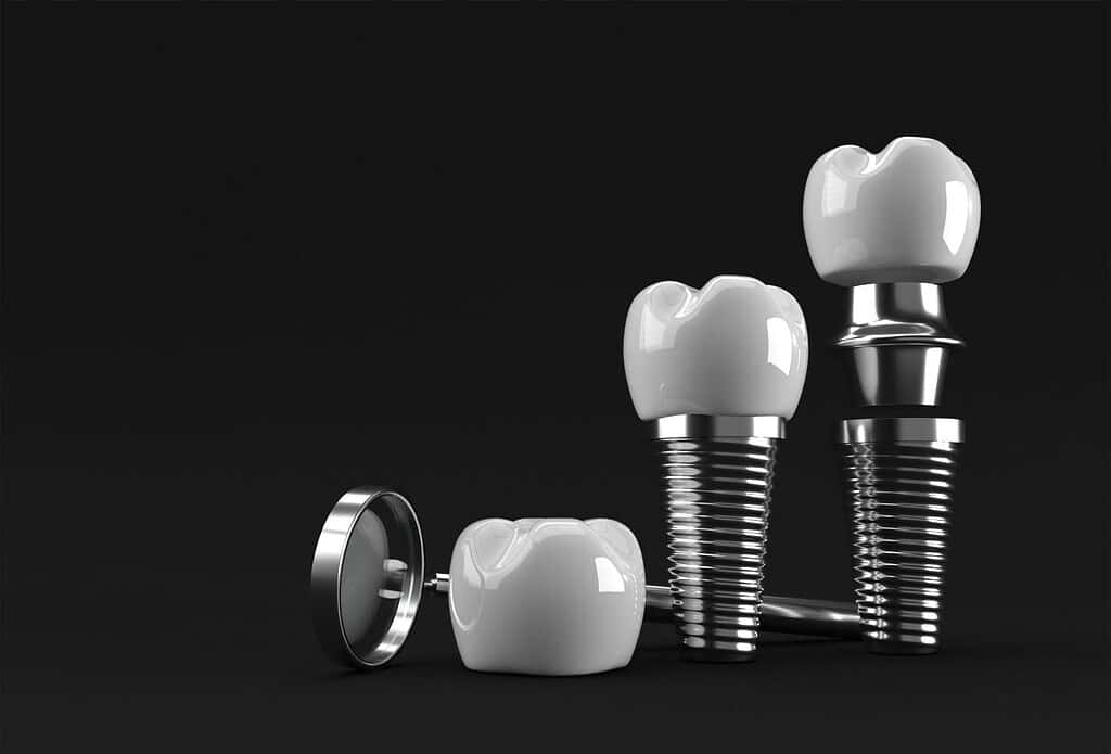  implantes dentales asequibles en Albania