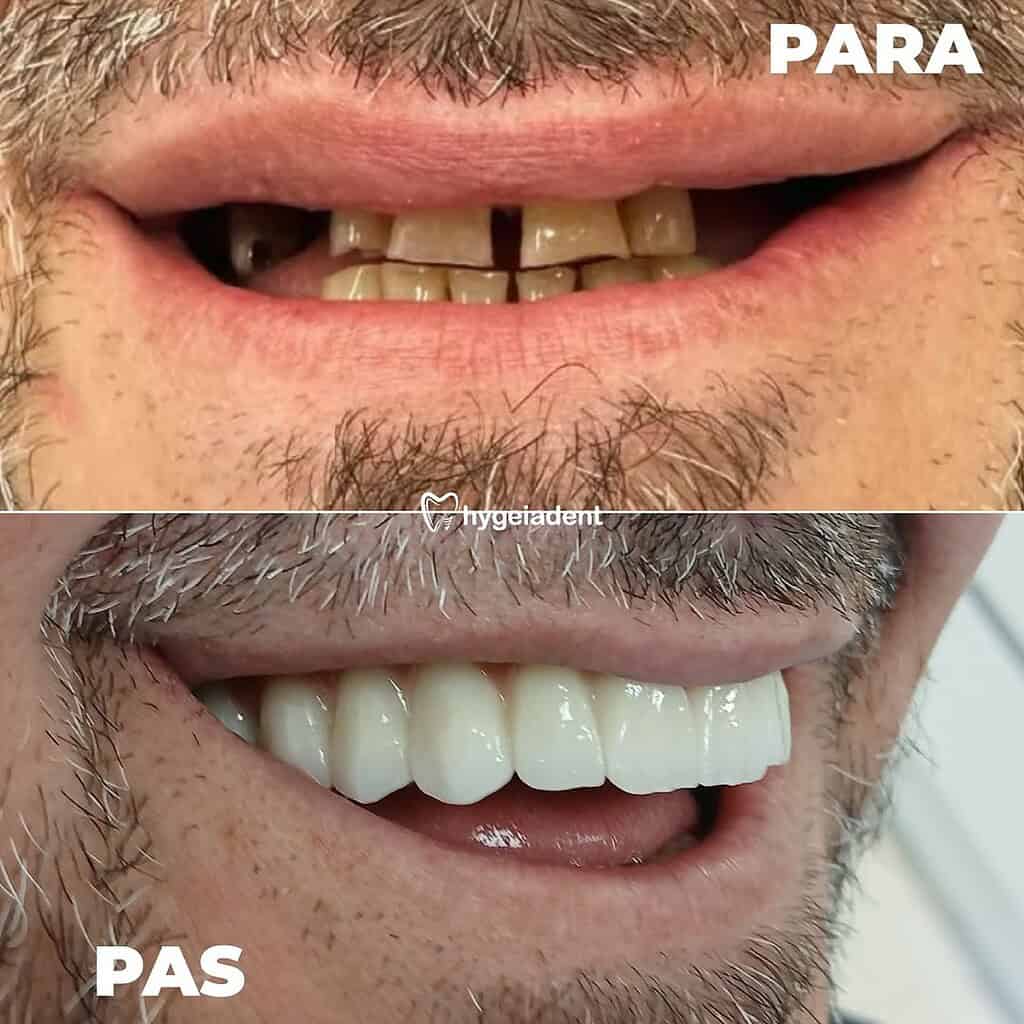 implantes dentales en Albania resultados antes y después