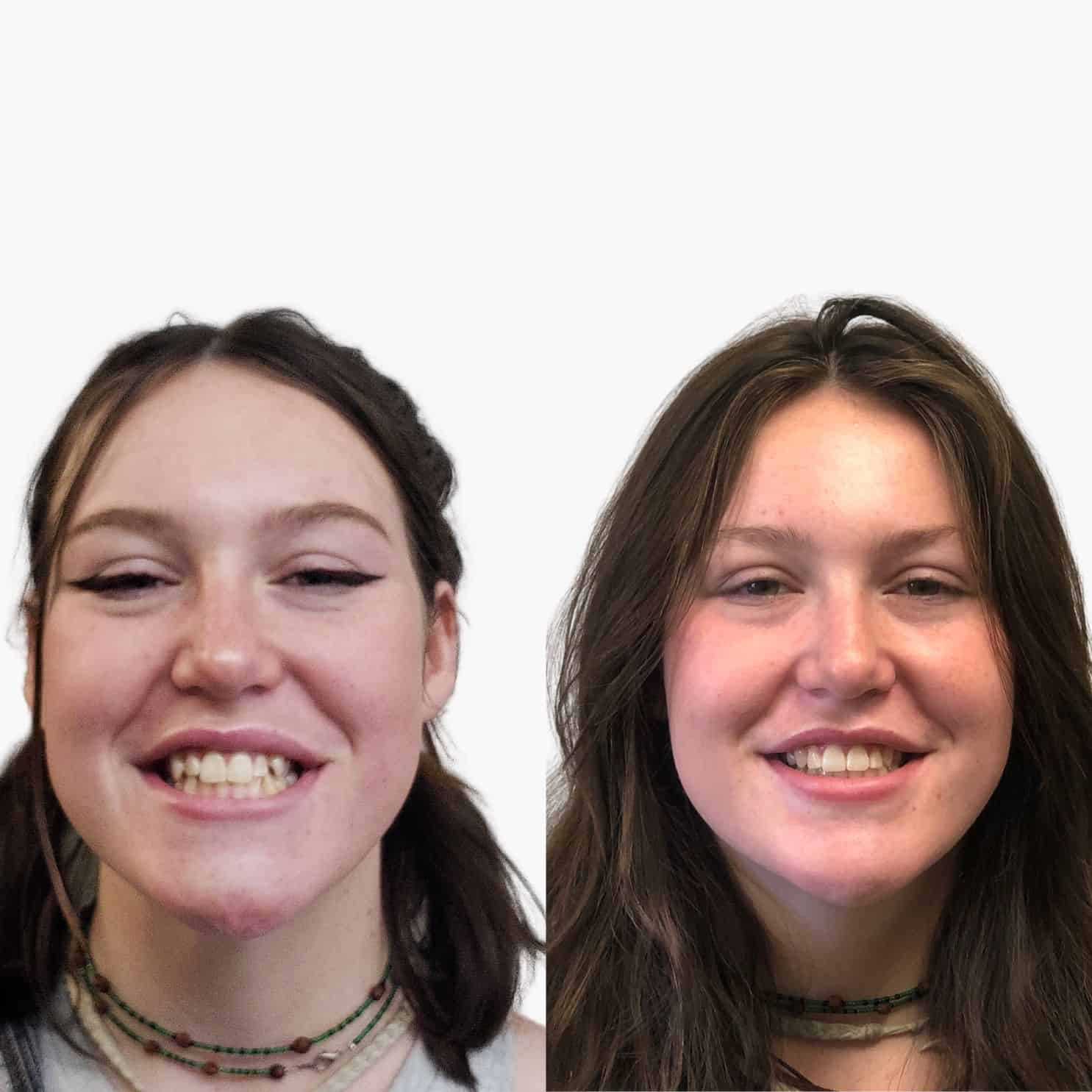 Prima Dopo Invisalign in Albania Foto