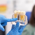 Implantet dentare në Shqipëri gjatë planit të trajtimit me një dentist në Shqipëri