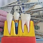 Çmimet e implanteve dentare në Shqipëri me oferta të qarta dhe transparente.