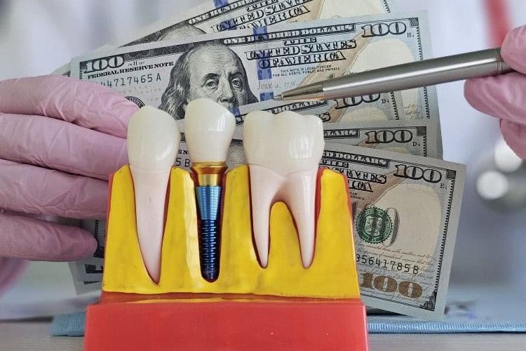 Çmimet e implanteve dentare në Shqipëri me oferta të qarta dhe transparente.