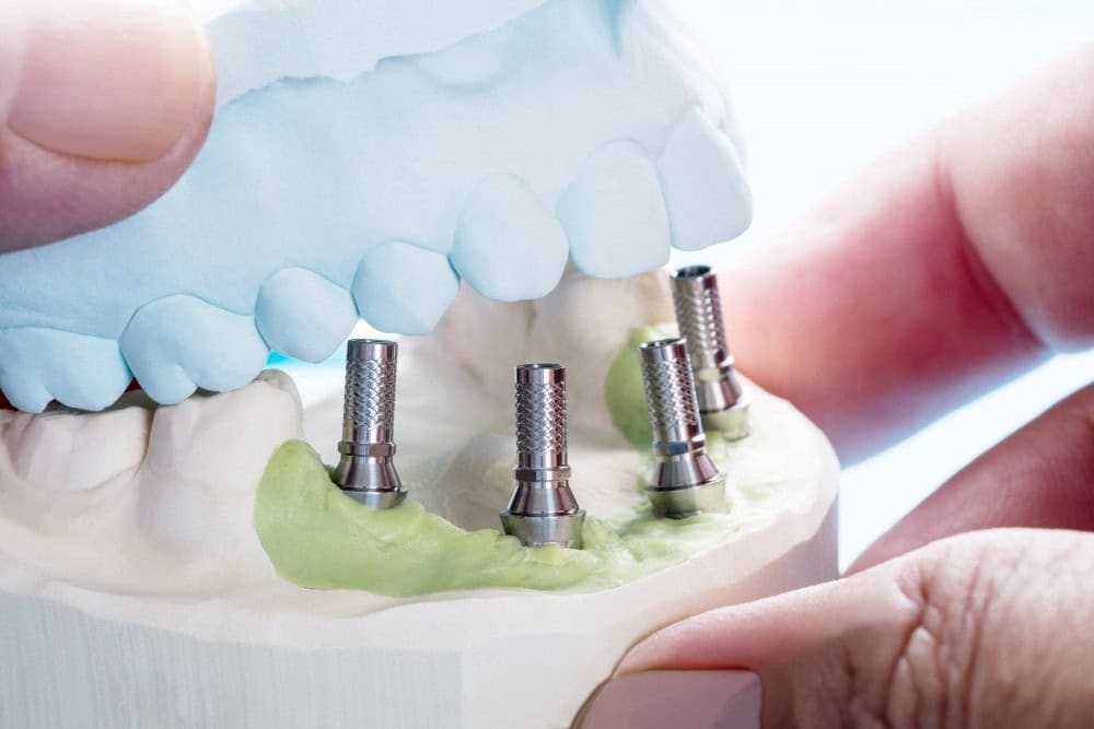 Implantet dentare All-on-4 në Shqipëri – pa dhimbje