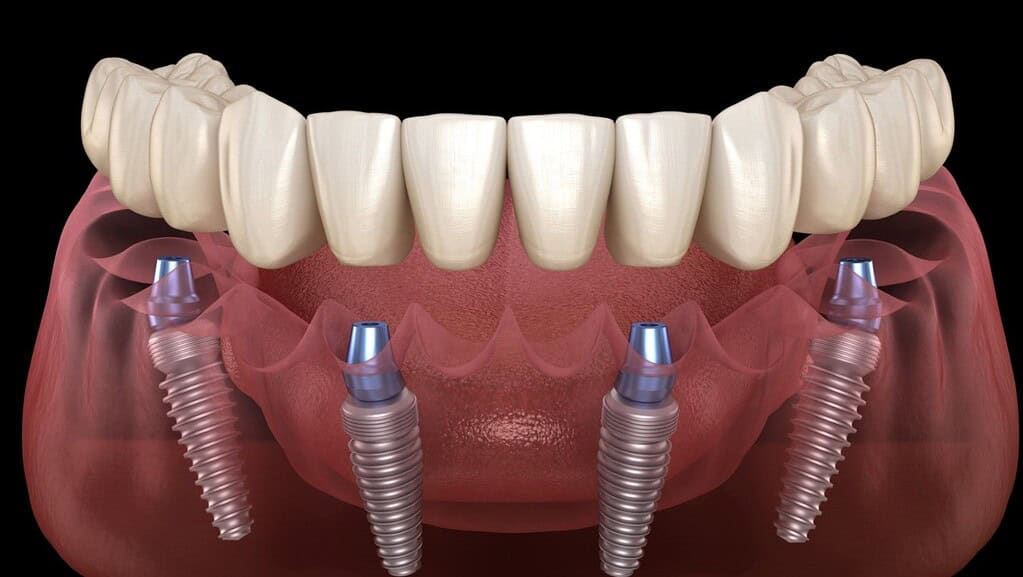 Tratamiento All-on-4 en Albania con arco fijo sobre implantes para pacientes de turismo dental en Albania
