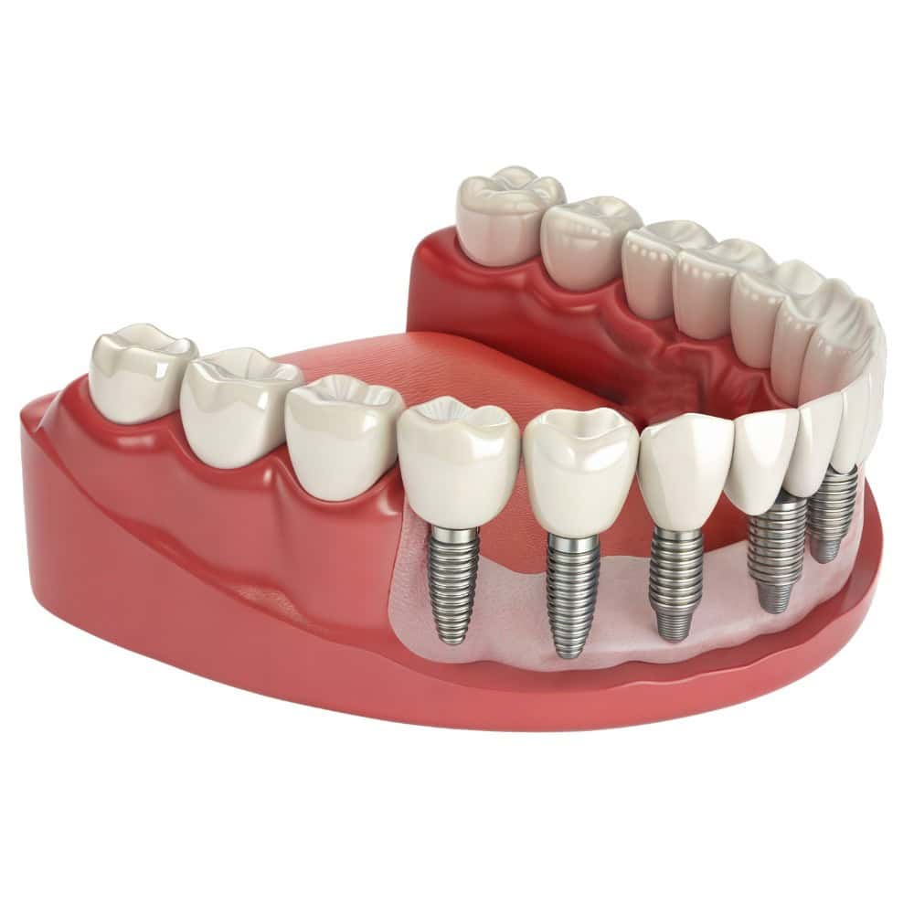 Comprobación de los implantes dentales Albania con la tecnología digital en la clínica de turismo dental en Albania