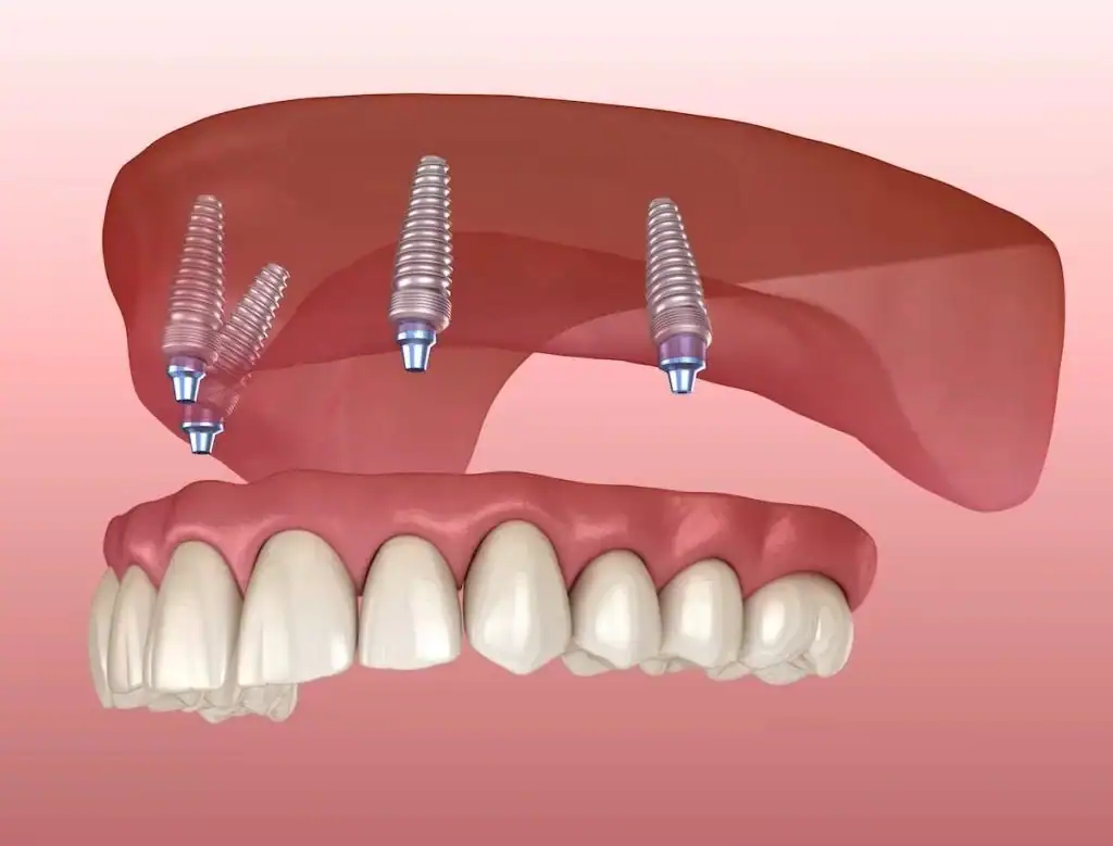 Çmimi i implantateve dentare All-on-4 me vida titani dhe kurora qeramike.
