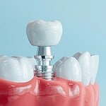 Dental implant in Albania for tooth replacement and dental restoration.