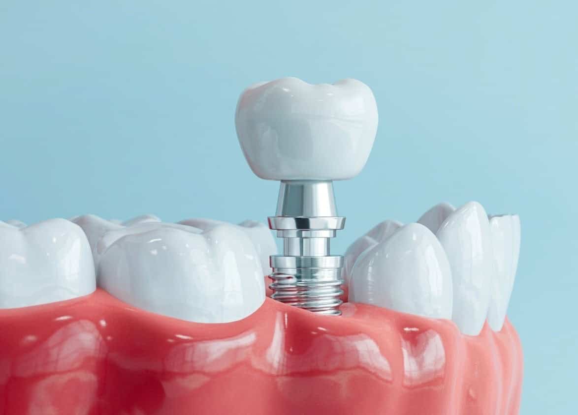 Impianto Singolo o Ponte Dentale? Come Scegliere la Soluzione Giusta
