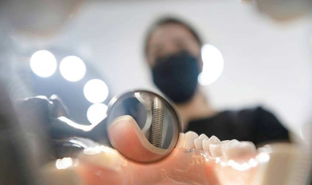 Dentista che mostra un impianto dentale durante una visita specialistica per implantologia dentale in Albania