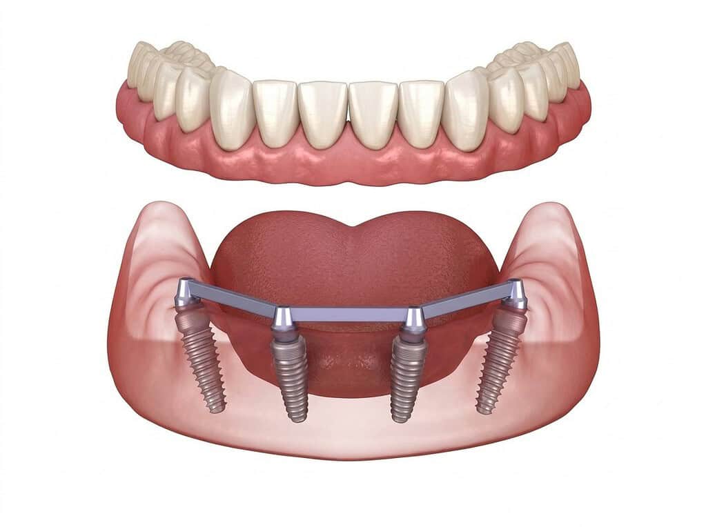 Schema illustrativo di impianti dentali All-on-4 in Albania per sostituire un’intera arcata dentale