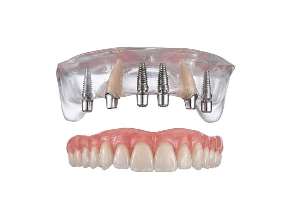 Protesi dentale fissa su impianti: soluzione avanzata di implantologia dentale in Albania per il sorriso completo