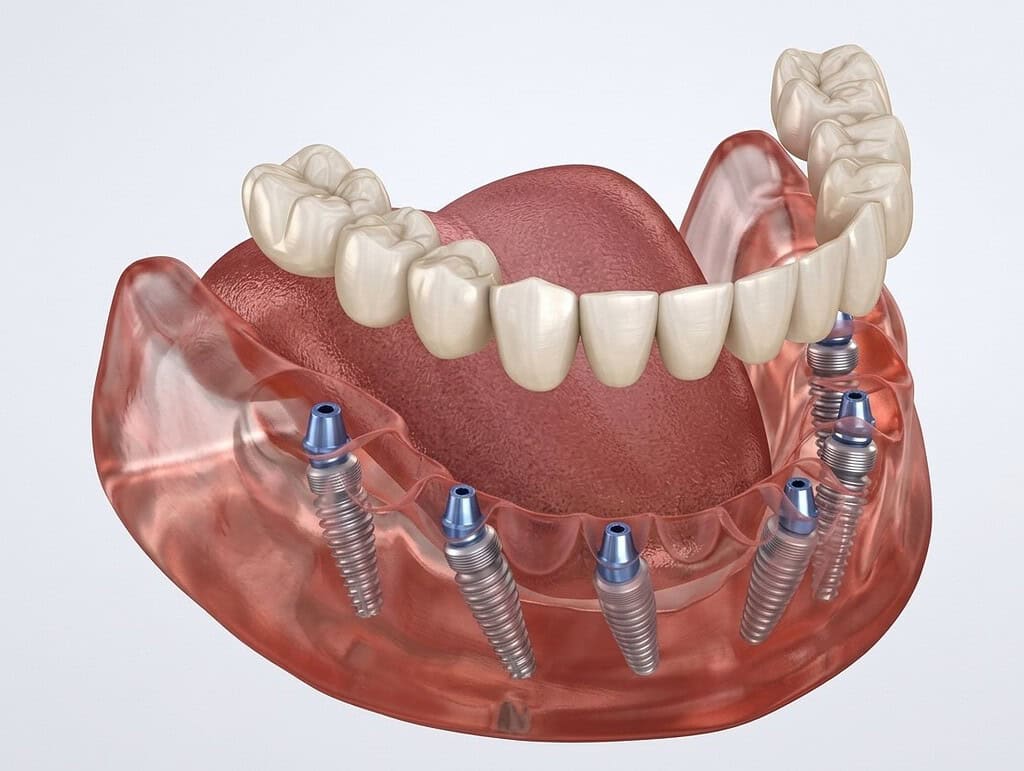 Illustrazione 3D di protesi fissa su impianti dentali All-on-6 in Albania