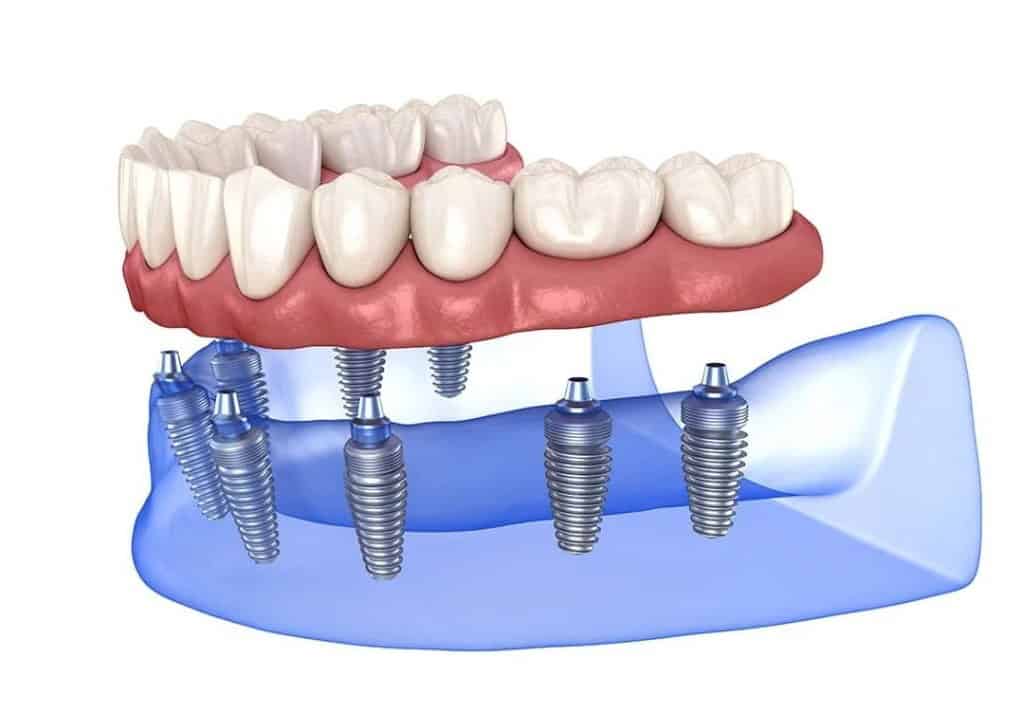 Illustrazione 3D di protesi fissa su impianti dentali All-on-8