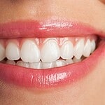 Dental veneers in Albania for natural-looking, aesthetic smile enhancement.