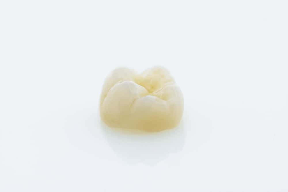 Dental crown used in full mouth rehabilitation at a dental clinic in Albania.