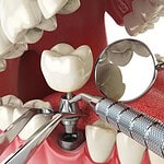 Dental clinic in Albania showing temporary crown placement on dental implant.