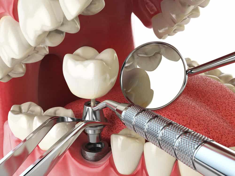 Dental clinic in Albania showing temporary crown placement on dental implant.
